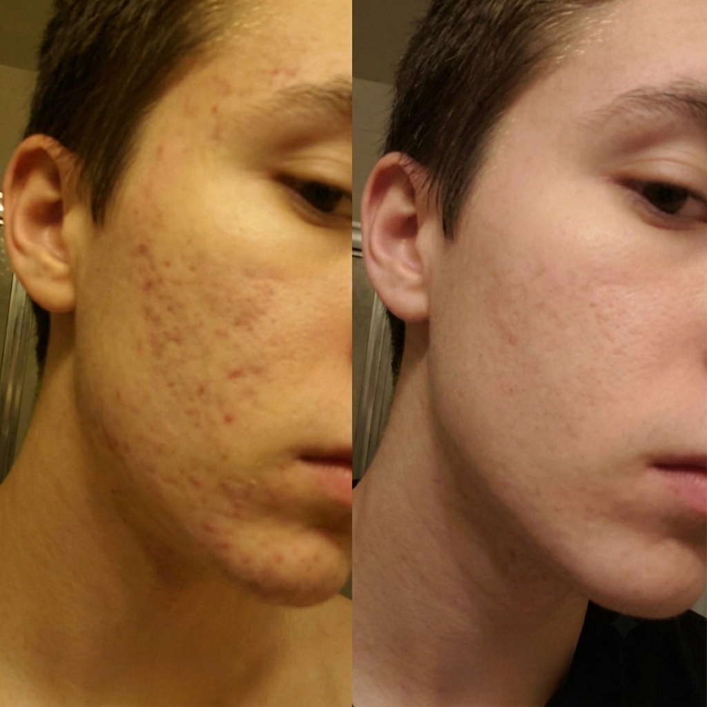 Acne Stick™ – Stick Riparatore per Cicatrici da Acne